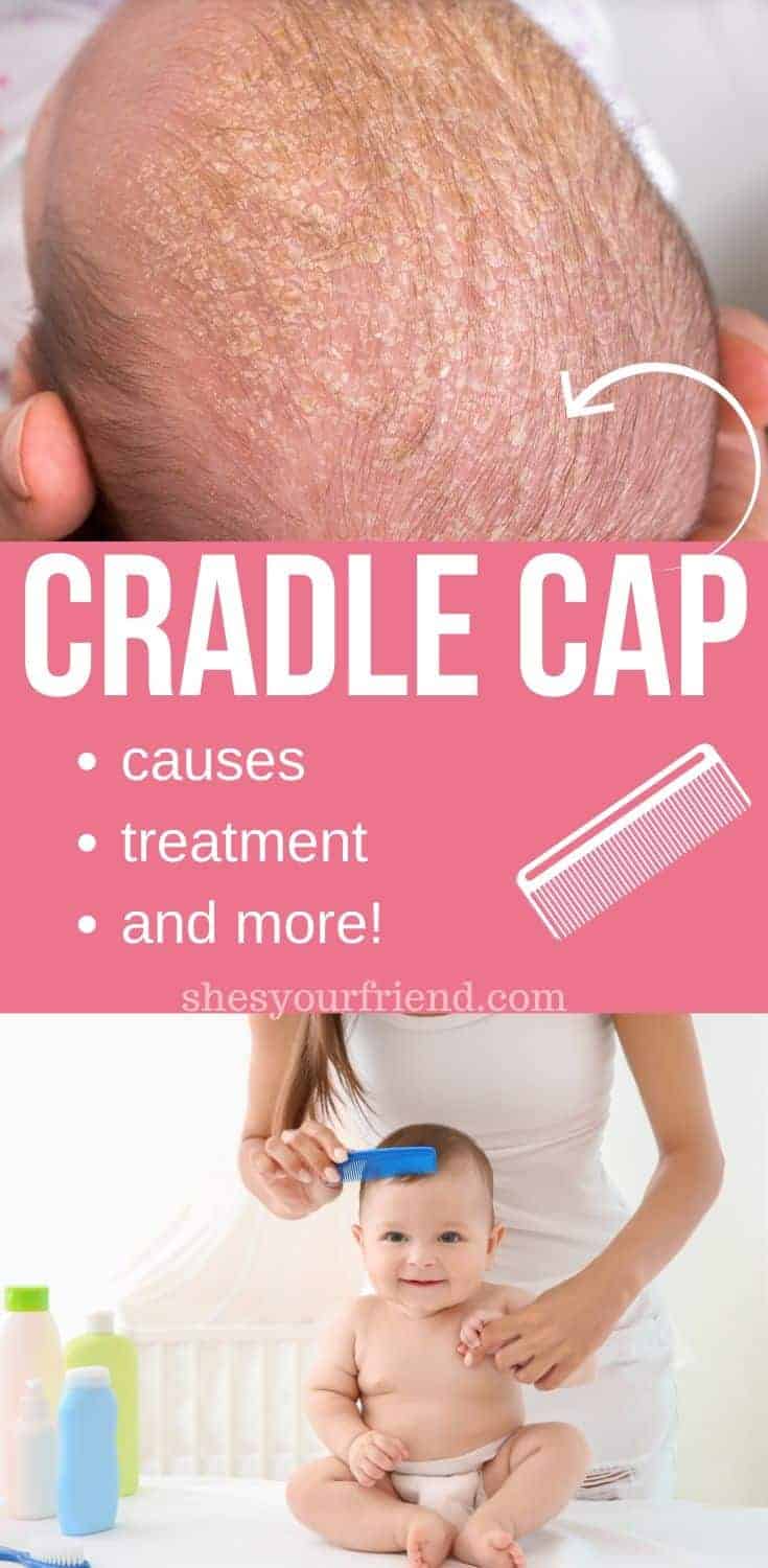 Complete guide to Cradle Cap and Baby She's Your Friend