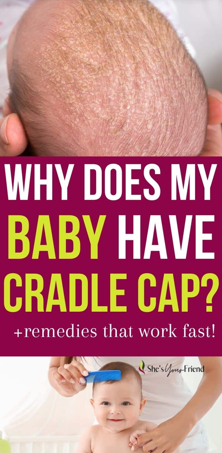 Complete guide to Cradle Cap and Baby She's Your Friend