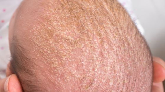 a close up look at a baby's head with cradle cap