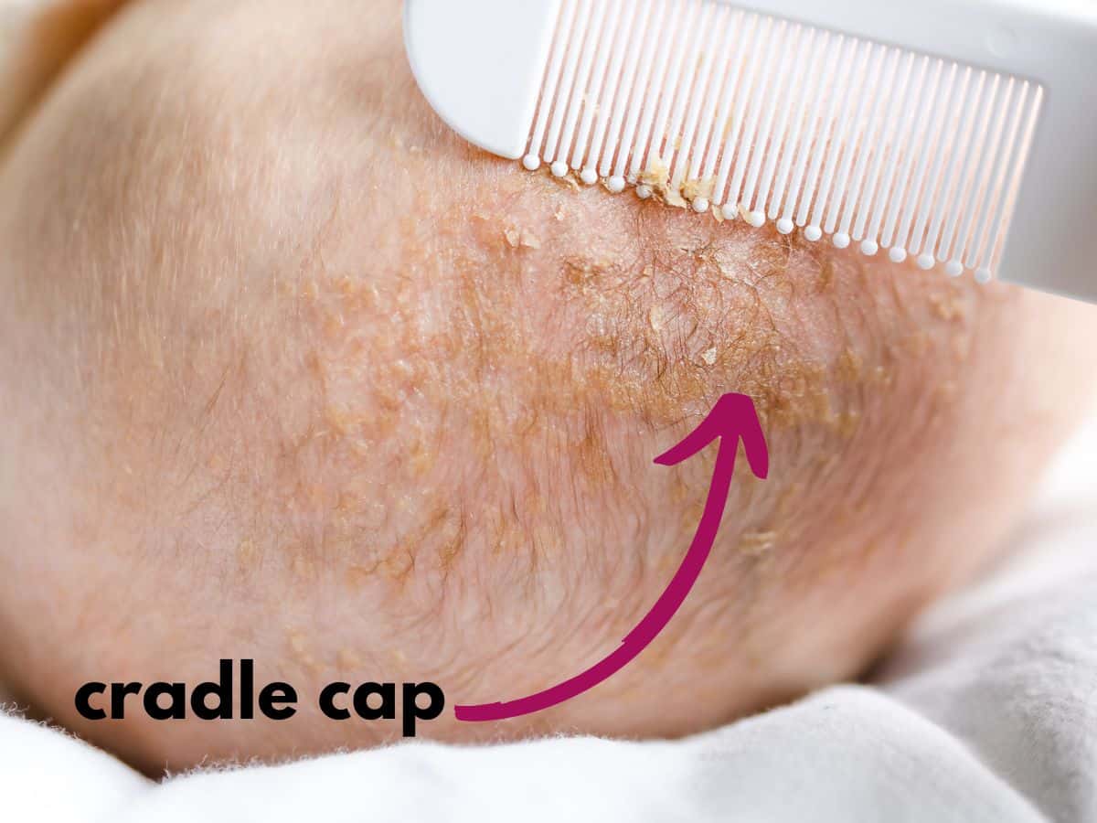 a comb brushing a baby's head with text overlay that reads cradle cap and an arrow