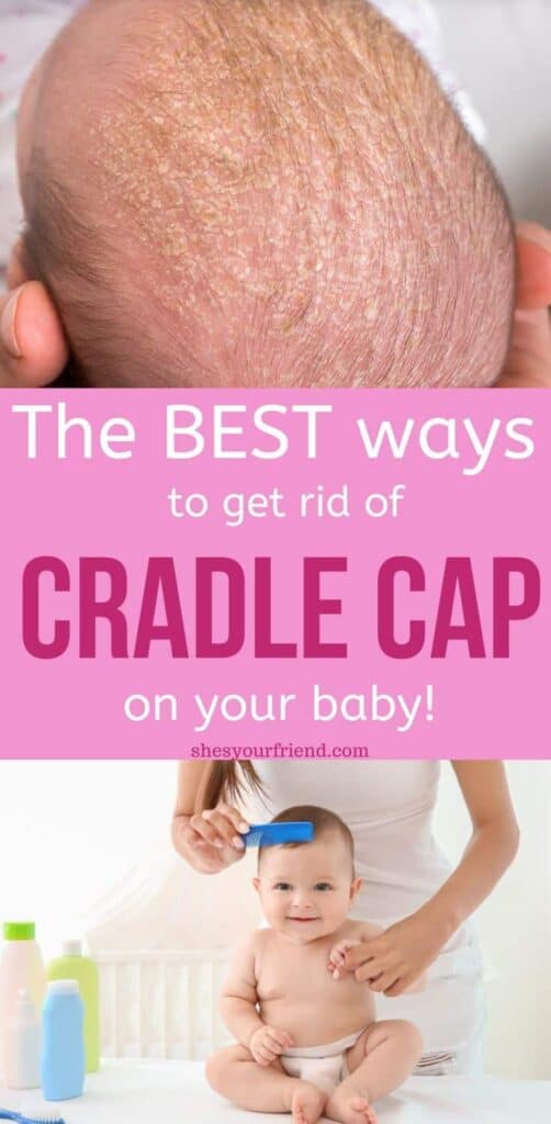 baby with cradle cap