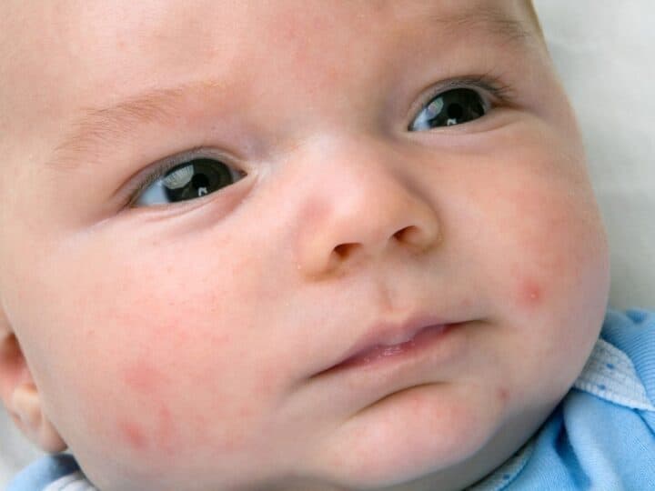 close up image of a baby with acne on his face