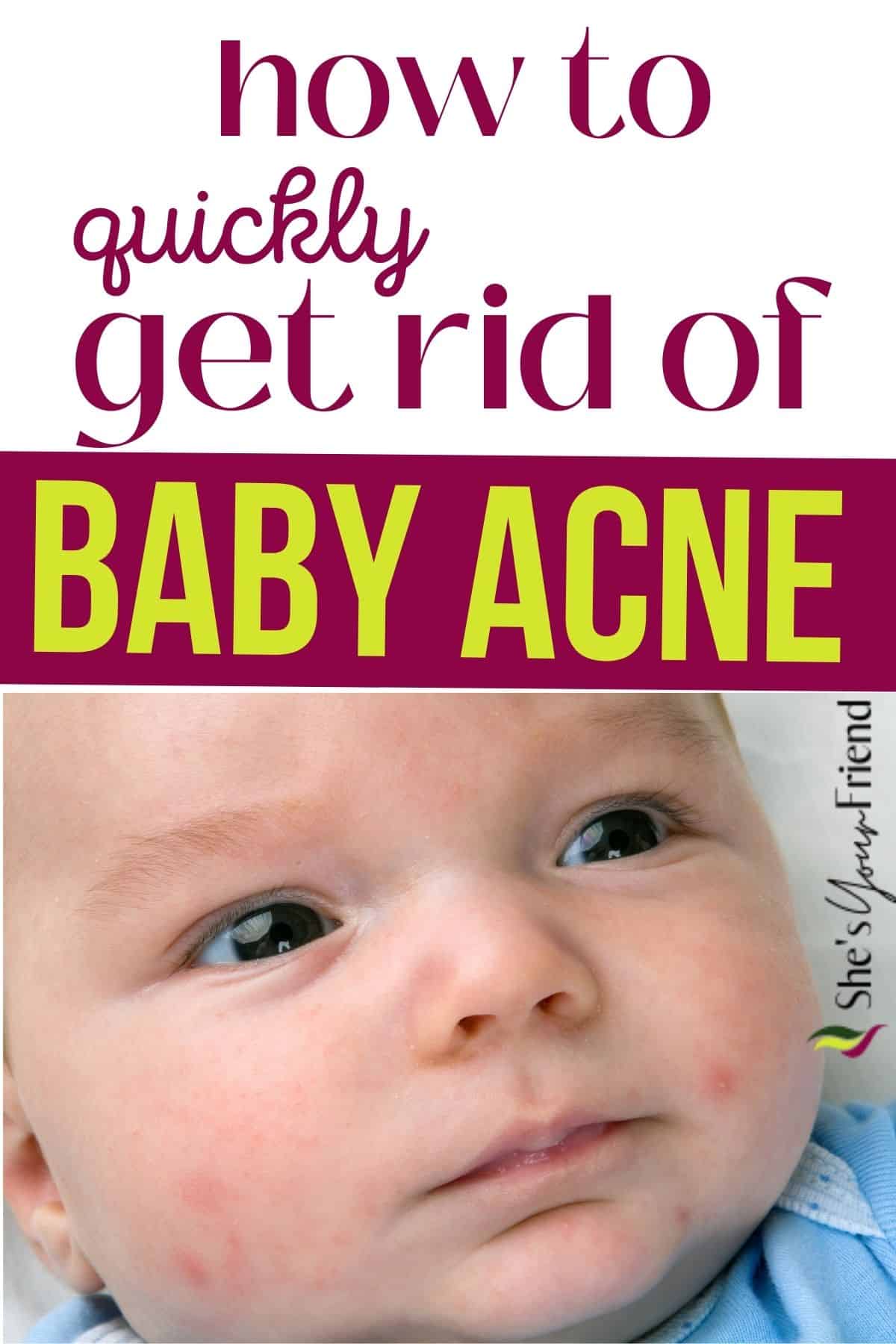 how-to-get-rid-of-baby-acne-she-s-your-friend